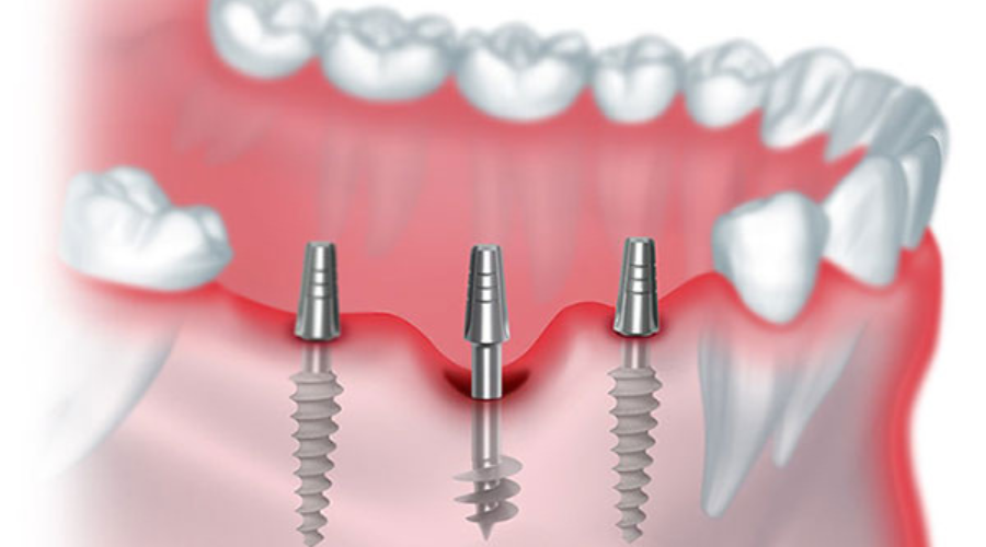 Happy person with braces